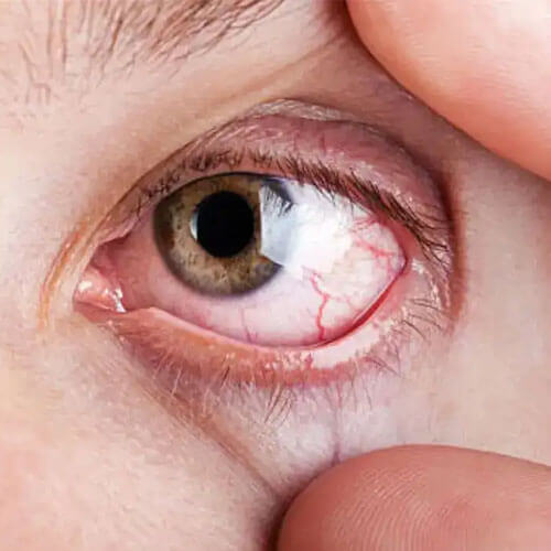 AC, Heat, and Screens: The Hidden Triple Attack Drying Out Your Eyes in Summer